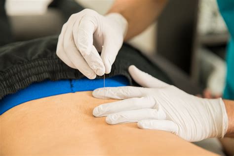 dry needling  choice physical therapy