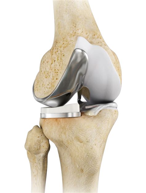 unicondylar knee replacement minimally invasive surgery knee