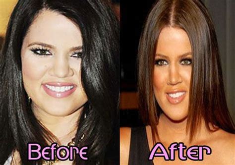 khloe kardashian before and after nose job celebrity before and after khloe kardashian