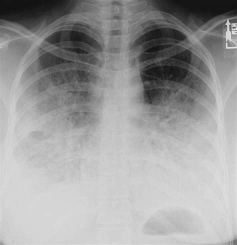 bilateral double pneumonia ehealthstar