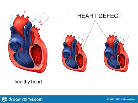 heart disease defect stock vector illustration  aorta