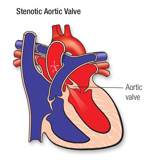 Aortic Valve Stenosis Avs Go Red For Women