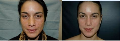 rejuv spa tratment casey cosmetic surgery facial