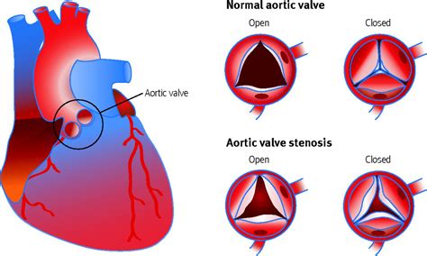 aortic stenosis diagnosis  management  bmj