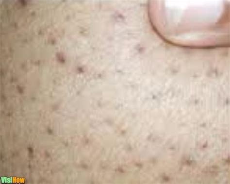 Get Rid Of Blackheads On Your Inner Thighs With