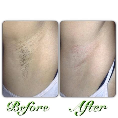 manzilian waxing before and after underarm waxing before and after picture yelp