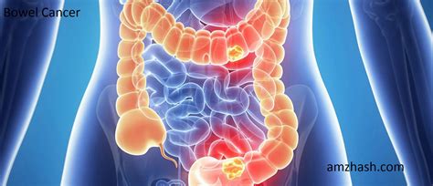 bowel cancercolorectal cancer     common types  cancer
