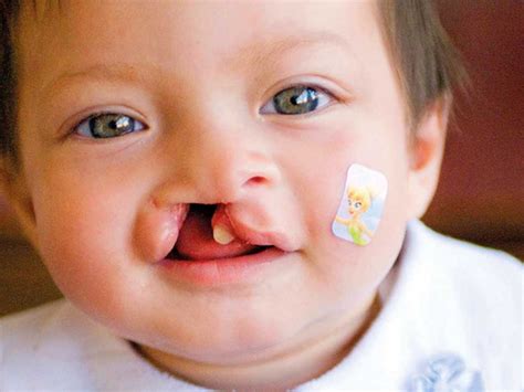 Charity Offers Free Cleft Palate And Lip Surgeries In Uae