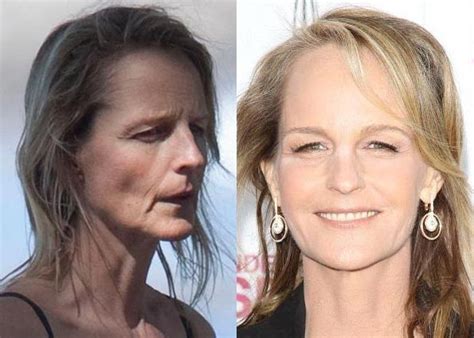 Helen Hunt Before And After Plastic Surgery Plastic