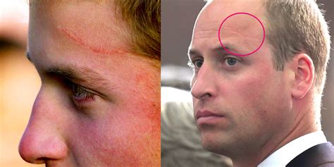 prince william   forehead scar prince william   harry potter scar