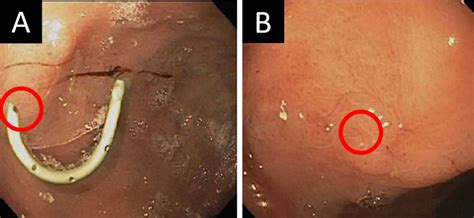 Gastric Access Temporary For Endoscopy Gate A Proposed Algorithm For