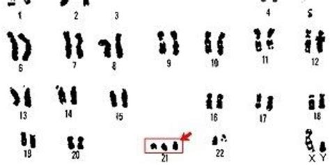 Trisomy 21 Effects Seen Genome Wide The Scientist Magazine®