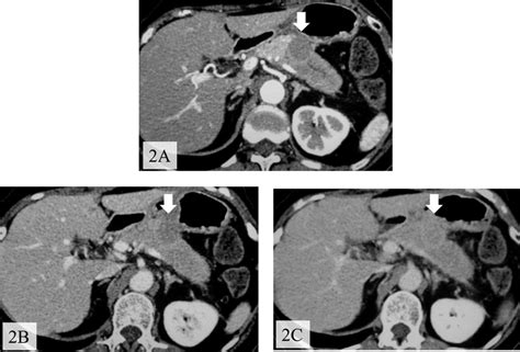 Enhanced Ct Showed A Tumor In The Body Of The Pancreas With Delayed