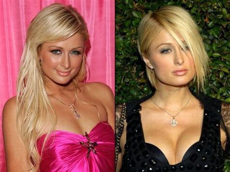 paris hilton plastic surgery before and after