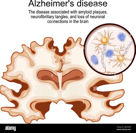 alzheimers disease disease   amyloid plaques