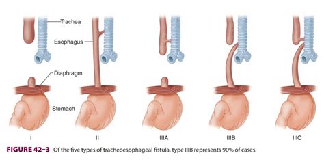 Anesthetic Considerations In Tracheoesophageal Fistula