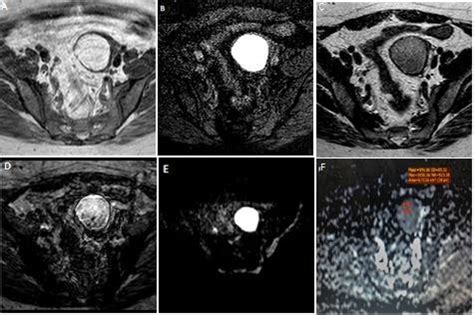 pelvic mri examination revealed left ovarian cyst  hemorrhagic  scientific diagram