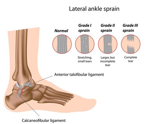 sprained ankle definition anatomy   video jeffrey  berg md