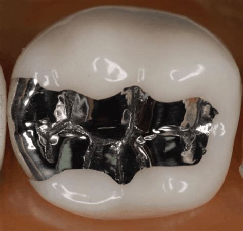 Class Ii Amalgam Restoration Stevenson Dental Solutions