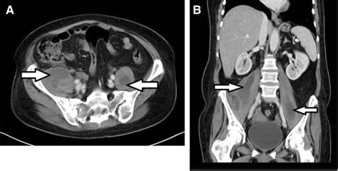 Bilateral Primary Psoas Abscesses Due To Methicillin Resistant