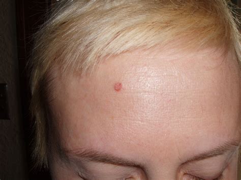 small red bump  forehead pictures  vrogueco