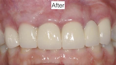 Receding Gum Tissue Around Dental Implant Kazemi Oral