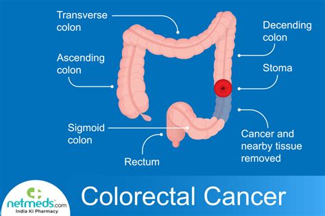 Rectal Tumor