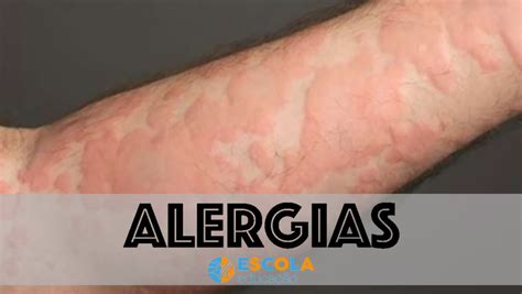 alergias   sao causas sintomas tratamento cura