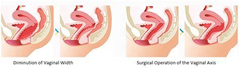 Aesthetic Vaginal Surgery Vaginoplasty And Labiaplasty