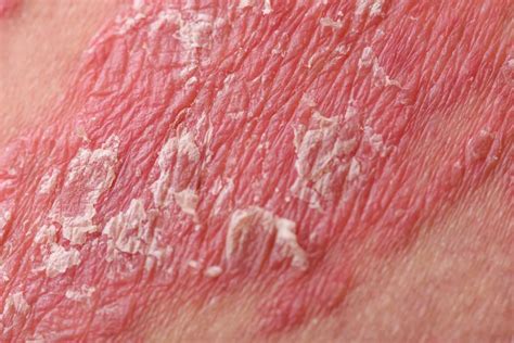 symptomes du cancer de la peau