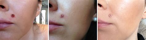 Before And After Mole Removal With Apple Cider Vinegar Alqurumresort