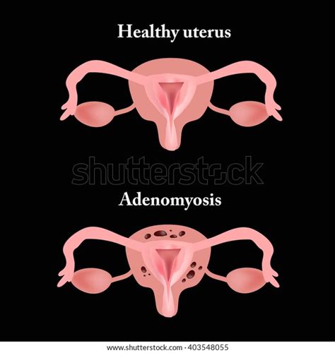 Endometriosis Structure Pelvic Organs Adenomyosis Endometrium Stock