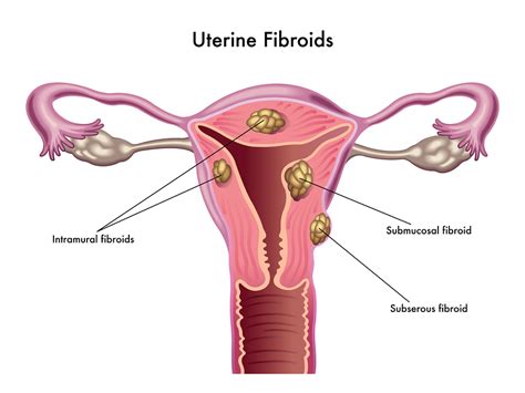 Uterine Fibroids Leiomyoma Toronto Naturopath Wellness Clinic
