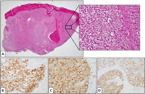 histological features  primary cutaneous anaplastic large cell
