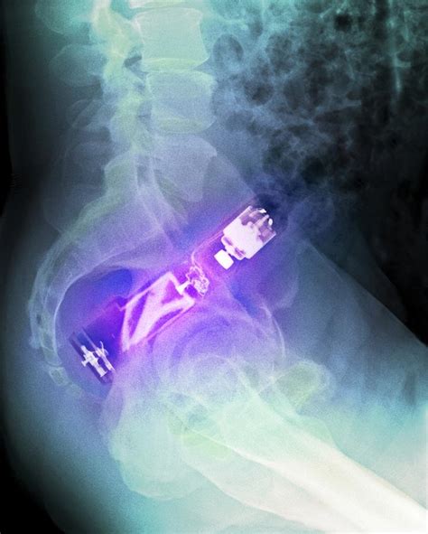 Electric Toothbrush In The Rectum X Ray Photograph By Du Cane Medical