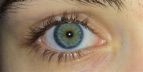 fileblue green eyes  central heterochromiajpg wikimedia commons