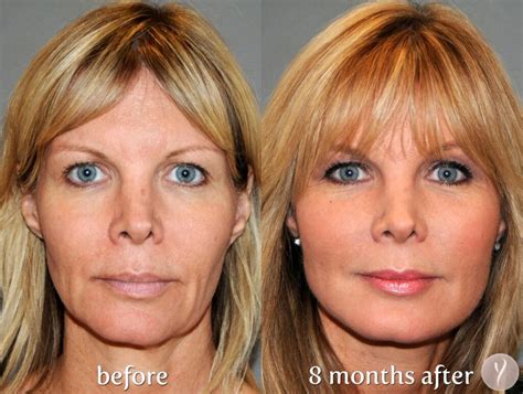 facelift surgery    significant facts