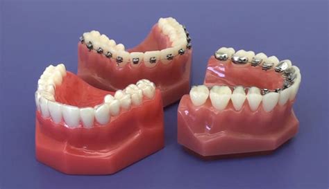 invisalign beugel dental correct invisalign