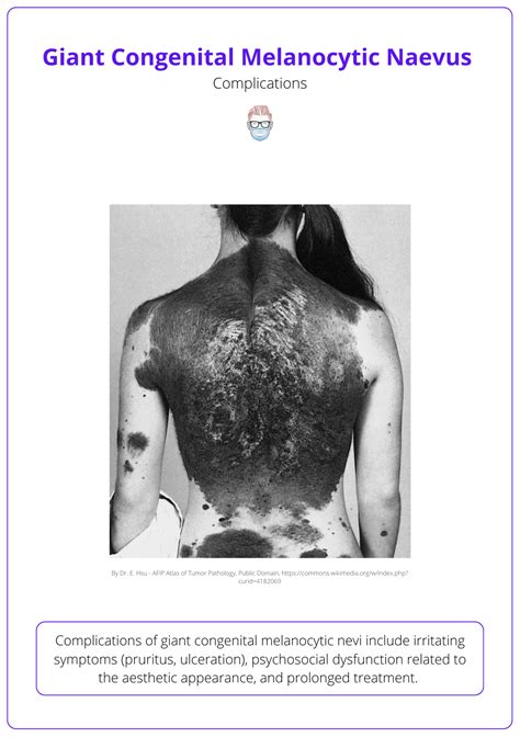 congenital melanocytic naevus define giant features management