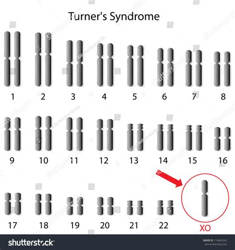 Monosomy X Turner Syndrome Stock Illustration 114645262 Shutterstock