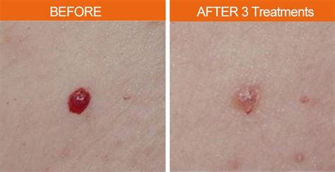 treating cherry angiomas with our lasers results aesthetictechnology