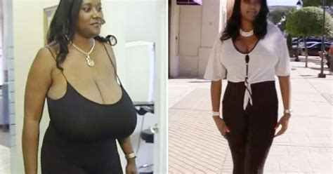 woman who had surgery to reduce 36nnn breasts says i couldn t even