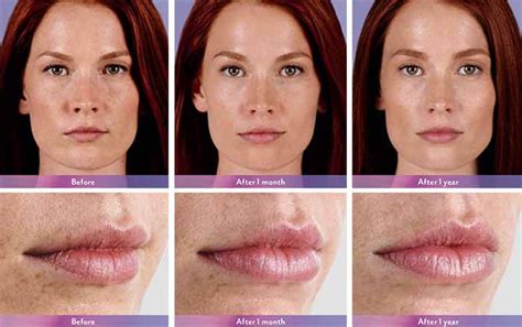 juvederm your trusted med spa in corte madera