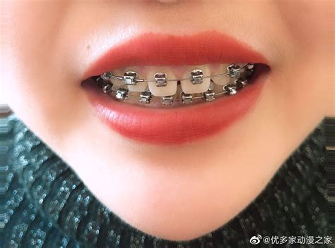 pin by evil h on kissable braces colors braces girls braces