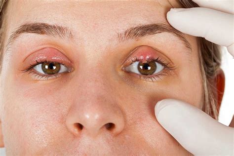 eyelid redness  symptoms inflamed dry itchy swollen red
