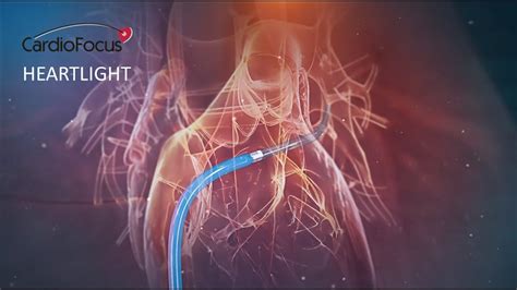irregular heartbeat treatment heartlight  cardiofocus  medical