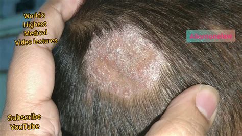 head scalp fungus