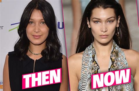 bella hadid plastic surgery makeover exposed by top doctors