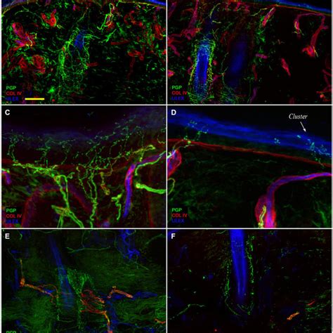 correlation between epidermal nerve fiber enf density and phn