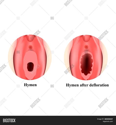 structure vulva hymen image and photo free trial bigstock